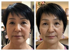 見た目年齢を決めるのは 顔の です 比較画像あり エクセレントラインプログラム